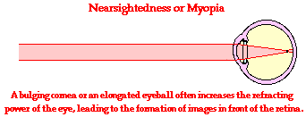 Nearsightedness and its Correction
