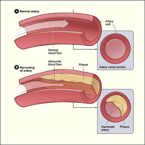 An illustration of an artery (hollow tube) that is clean, with a large cross section and normal blood flow rate.  Below is another artery (hollow tube) that has plaque build up, showing that the plaque causes a narrowing of the cross section and thus increases the blood flow.