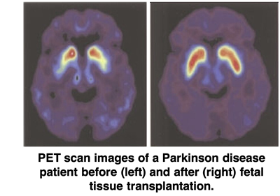 Diagram of a PET scan of the brain of a Parkinson patient, before and after fetal tissue transplantation.
